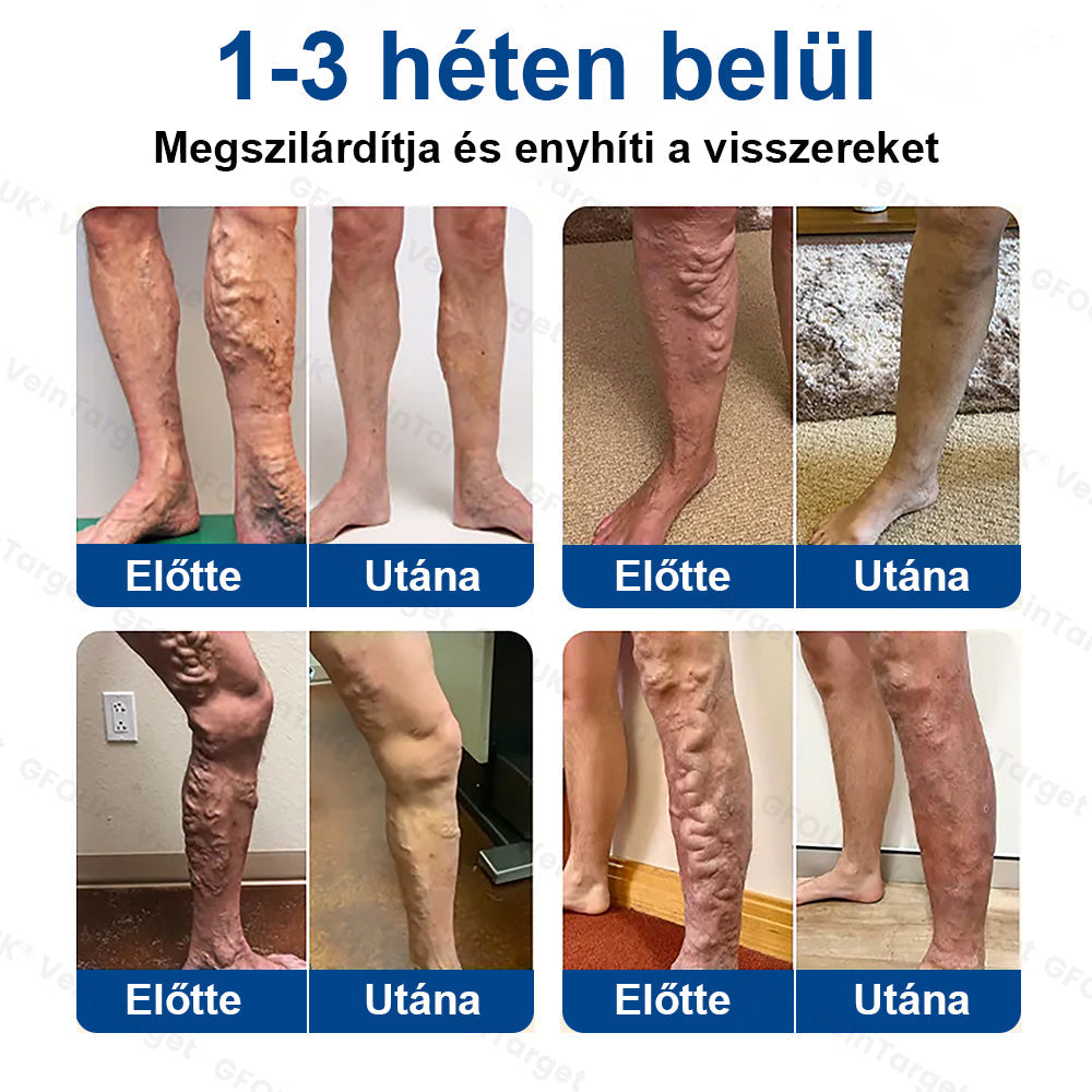 ✅Laleia® Vein Ease mikrotűs tapasz