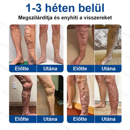 ✅Laleia® Vein Ease mikrotűs tapasz