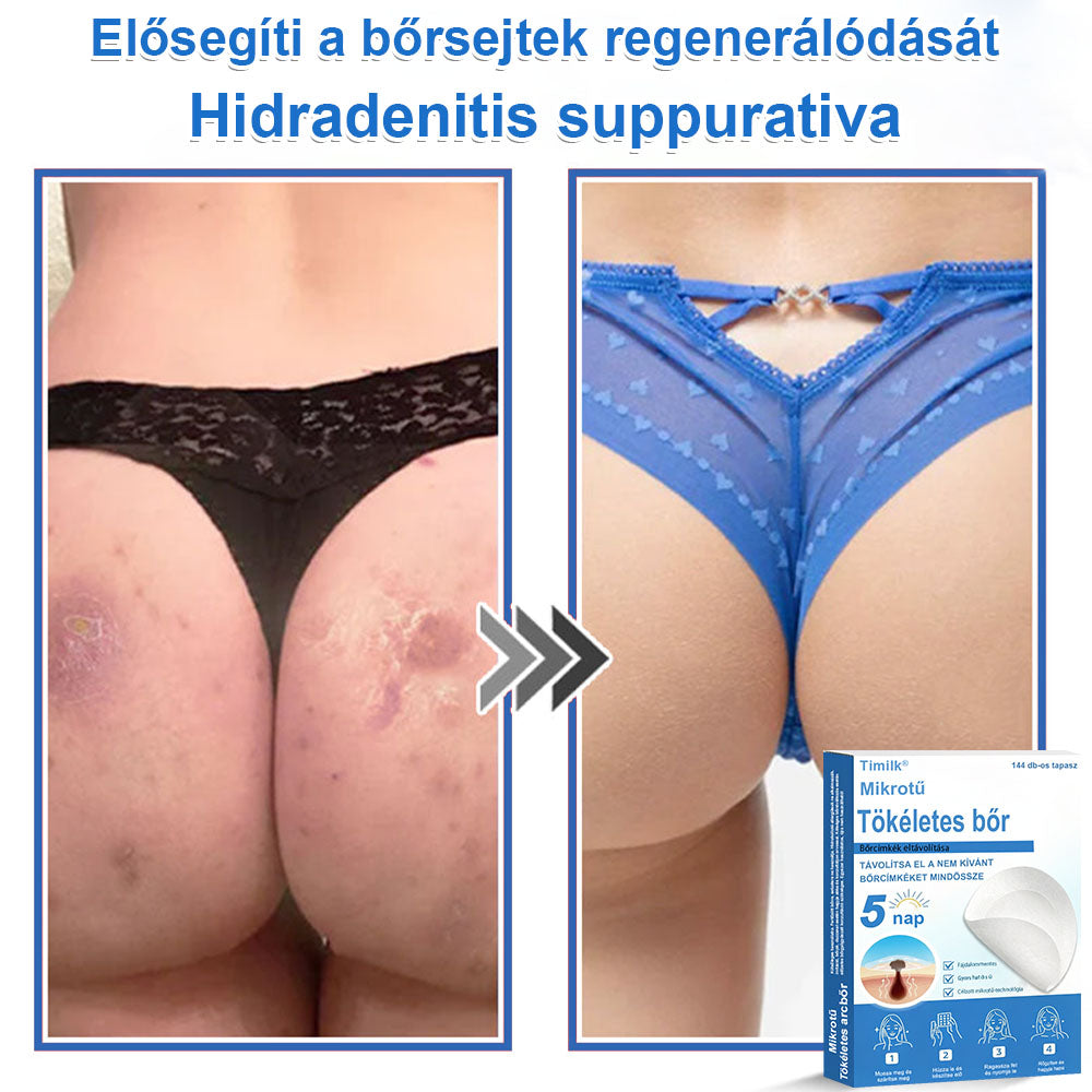 📌📌📌 Timilk® 2 az 1-ben mikrotűs és hidrokolloid tapasz | Kiemelkedő anyajegyek, pattanások, lapos szemölcsök és bőrkinövések eltávolítására | Segít javítani a ráncok, hegek és bőrhibák megjelenését | Láthatatlan pattanástapasz arcra és testre📌📌