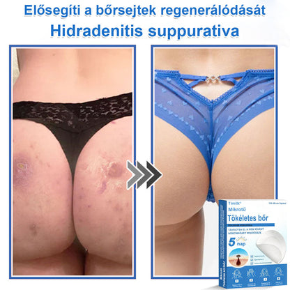 📌📌📌 Timilk® 2 az 1-ben mikrotűs és hidrokolloid tapasz | Kiemelkedő anyajegyek, pattanások, lapos szemölcsök és bőrkinövések eltávolítására | Segít javítani a ráncok, hegek és bőrhibák megjelenését | Láthatatlan pattanástapasz arcra és testre📌📌