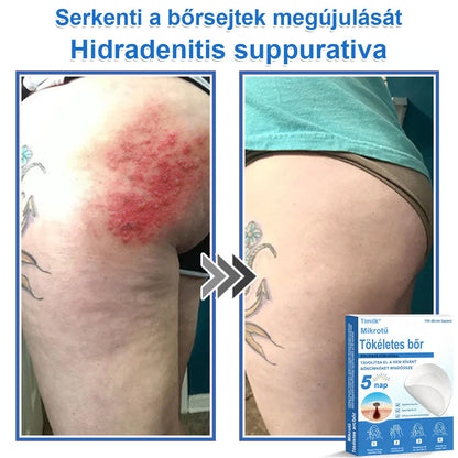 📌📌📌 Timilk® 2 az 1-ben mikrotűs és hidrokolloid tapasz | Kiemelkedő anyajegyek, pattanások, lapos szemölcsök és bőrkinövések eltávolítására | Segít javítani a ráncok, hegek és bőrhibák megjelenését | Láthatatlan pattanástapasz arcra és testre📌📌