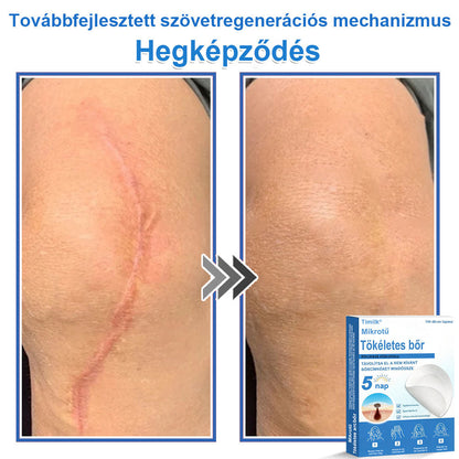 📌📌📌 Timilk® 2 az 1-ben mikrotűs és hidrokolloid tapasz | Kiemelkedő anyajegyek, pattanások, lapos szemölcsök és bőrkinövések eltávolítására | Segít javítani a ráncok, hegek és bőrhibák megjelenését | Láthatatlan pattanástapasz arcra és testre📌📌
