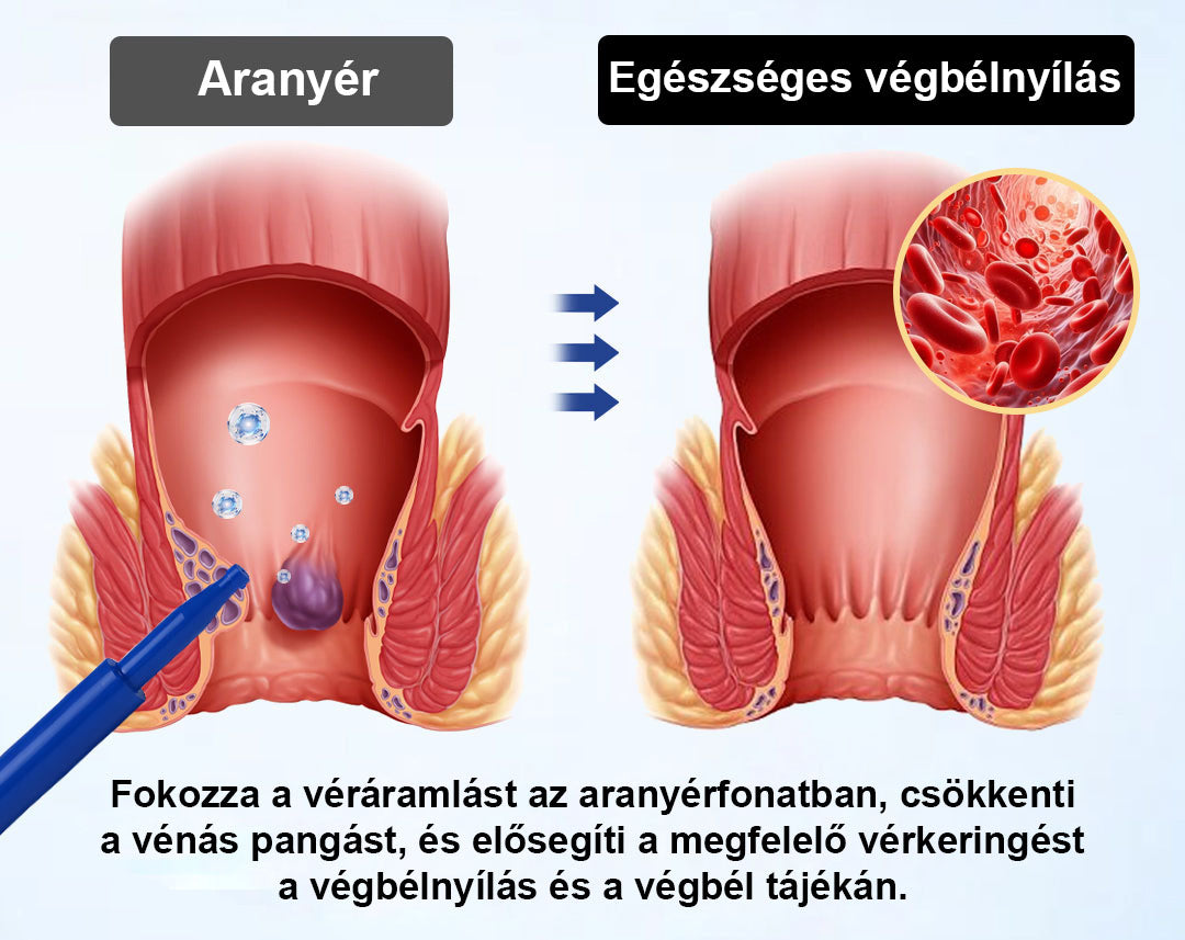🌿🌿 Timilk® ProctoEase nyugtató aranyérápoló gél🌿🌿🌿