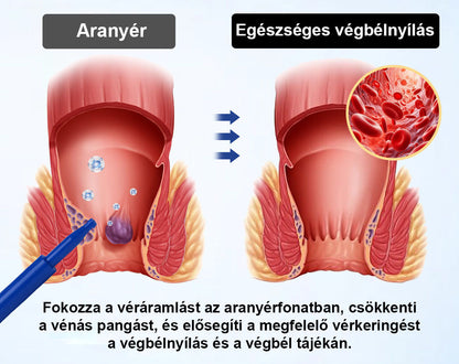 🌿🌿 Timilk® ProctoEase nyugtató aranyérápoló gél🌿🌿🌿