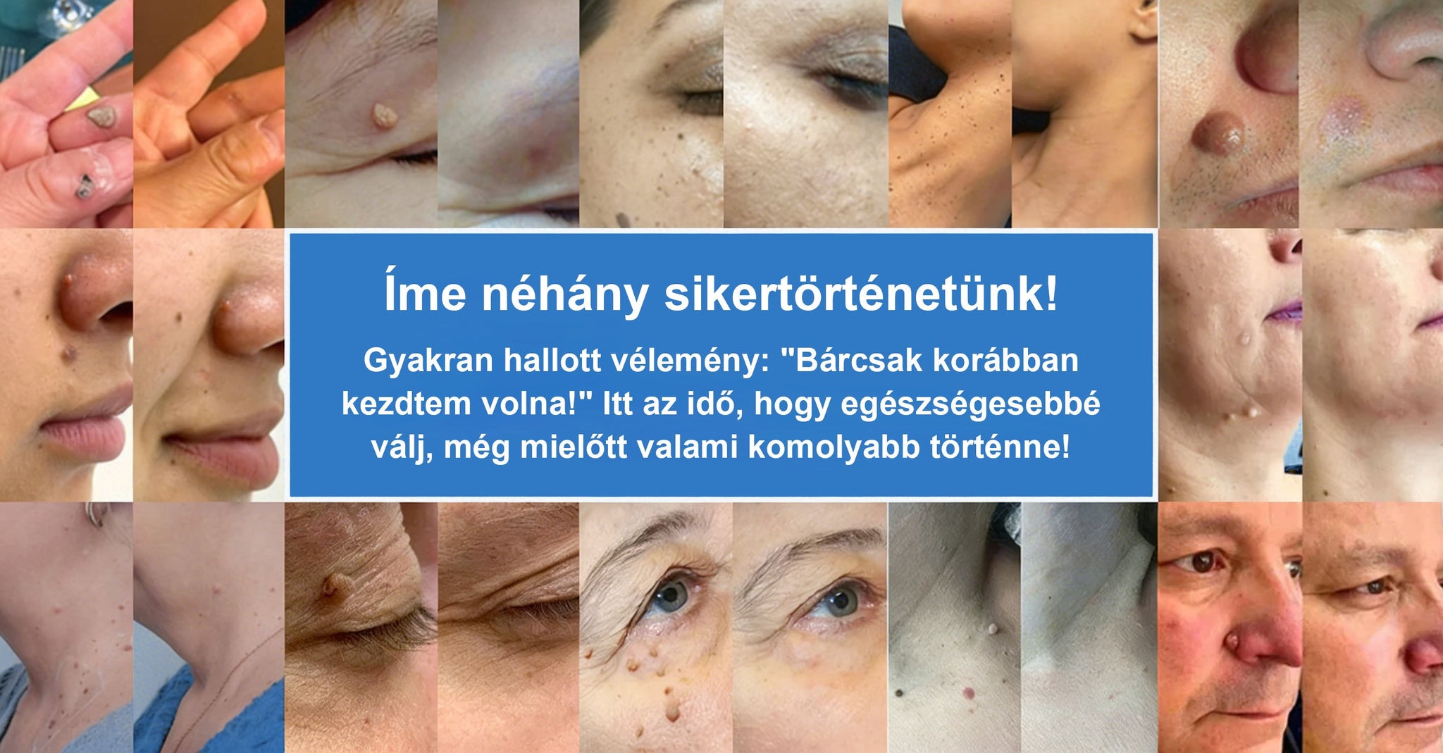 📌📌📌 Timilk® 2 az 1-ben mikrotűs és hidrokolloid tapasz | Kiemelkedő anyajegyek, pattanások, lapos szemölcsök és bőrkinövések eltávolítására | Segít javítani a ráncok, hegek és bőrhibák megjelenését | Láthatatlan pattanástapasz arcra és testre📌📌