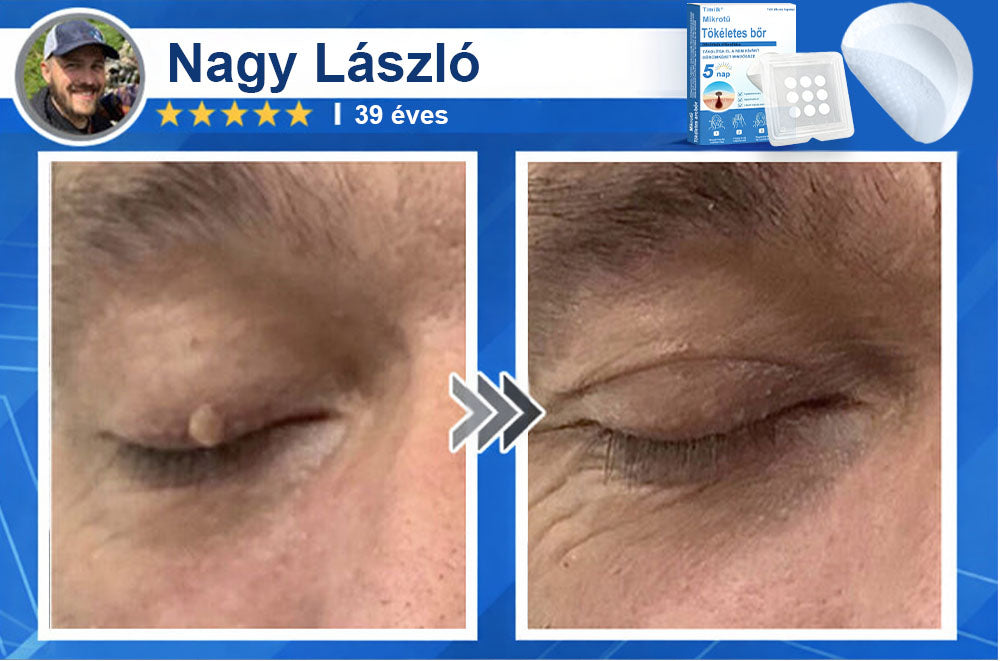 📌📌📌 Timilk® 2 az 1-ben mikrotűs és hidrokolloid tapasz | Kiemelkedő anyajegyek, pattanások, lapos szemölcsök és bőrkinövések eltávolítására | Segít javítani a ráncok, hegek és bőrhibák megjelenését | Láthatatlan pattanástapasz arcra és testre📌📌