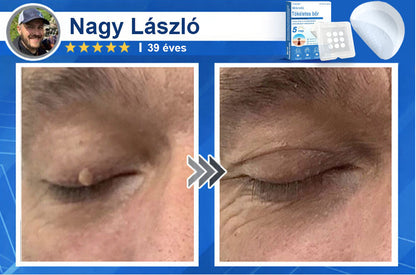 📌📌📌 Timilk® 2 az 1-ben mikrotűs és hidrokolloid tapasz | Kiemelkedő anyajegyek, pattanások, lapos szemölcsök és bőrkinövések eltávolítására | Segít javítani a ráncok, hegek és bőrhibák megjelenését | Láthatatlan pattanástapasz arcra és testre📌📌