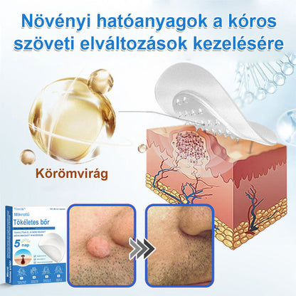 📌📌📌 Timilk® 2 az 1-ben mikrotűs és hidrokolloid tapasz | Kiemelkedő anyajegyek, pattanások, lapos szemölcsök és bőrkinövések eltávolítására | Segít javítani a ráncok, hegek és bőrhibák megjelenését | Láthatatlan pattanástapasz arcra és testre📌📌