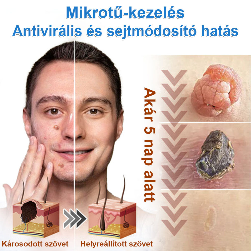 📌📌📌 Timilk® 2 az 1-ben mikrotűs és hidrokolloid tapasz | Kiemelkedő anyajegyek, pattanások, lapos szemölcsök és bőrkinövések eltávolítására | Segít javítani a ráncok, hegek és bőrhibák megjelenését | Láthatatlan pattanástapasz arcra és testre📌📌