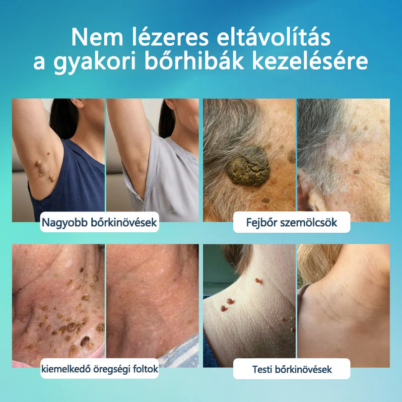 🖊🖊 Timilk® SpotlessPro Fejlett Bőrápoló Toll