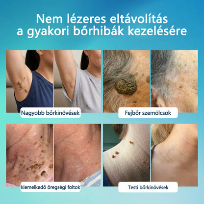 🖊🖊 Timilk® SpotlessPro Fejlett Bőrápoló Toll