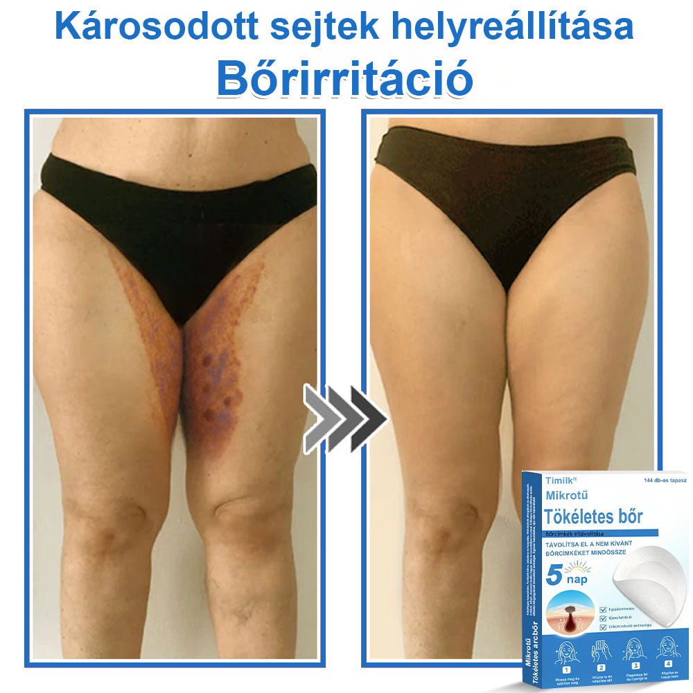 📌📌📌 Timilk® 2 az 1-ben mikrotűs és hidrokolloid tapasz | Kiemelkedő anyajegyek, pattanások, lapos szemölcsök és bőrkinövések eltávolítására | Segít javítani a ráncok, hegek és bőrhibák megjelenését | Láthatatlan pattanástapasz arcra és testre📌📌
