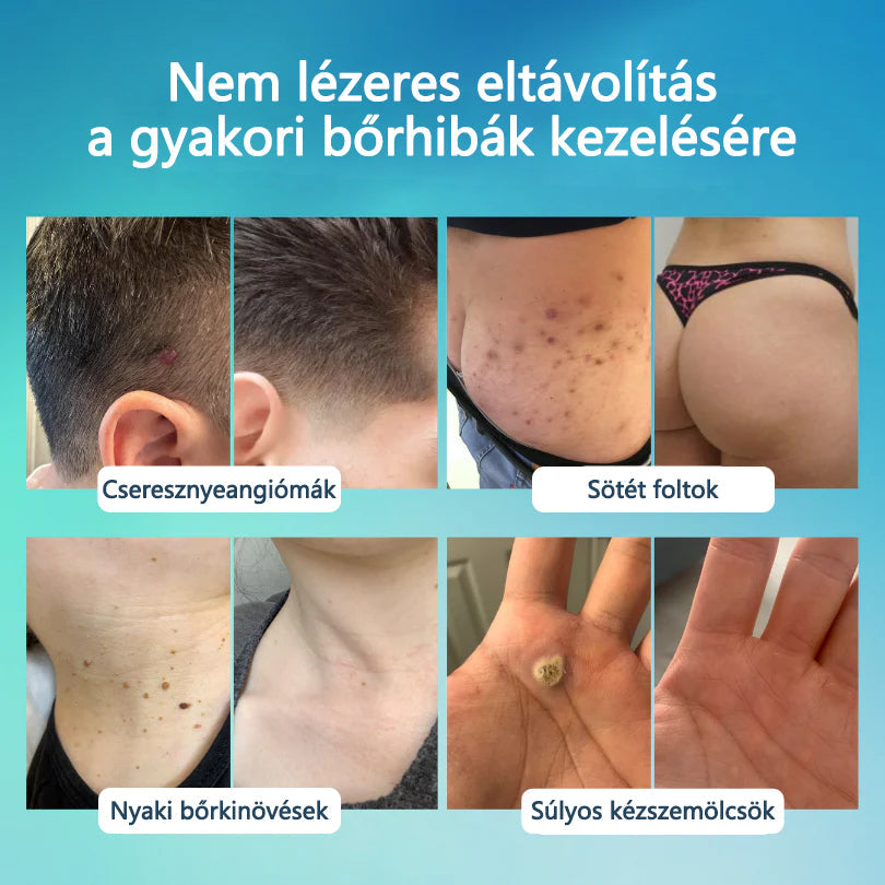 🖊🖊 Timilk® SpotlessPro Fejlett Bőrápoló Toll