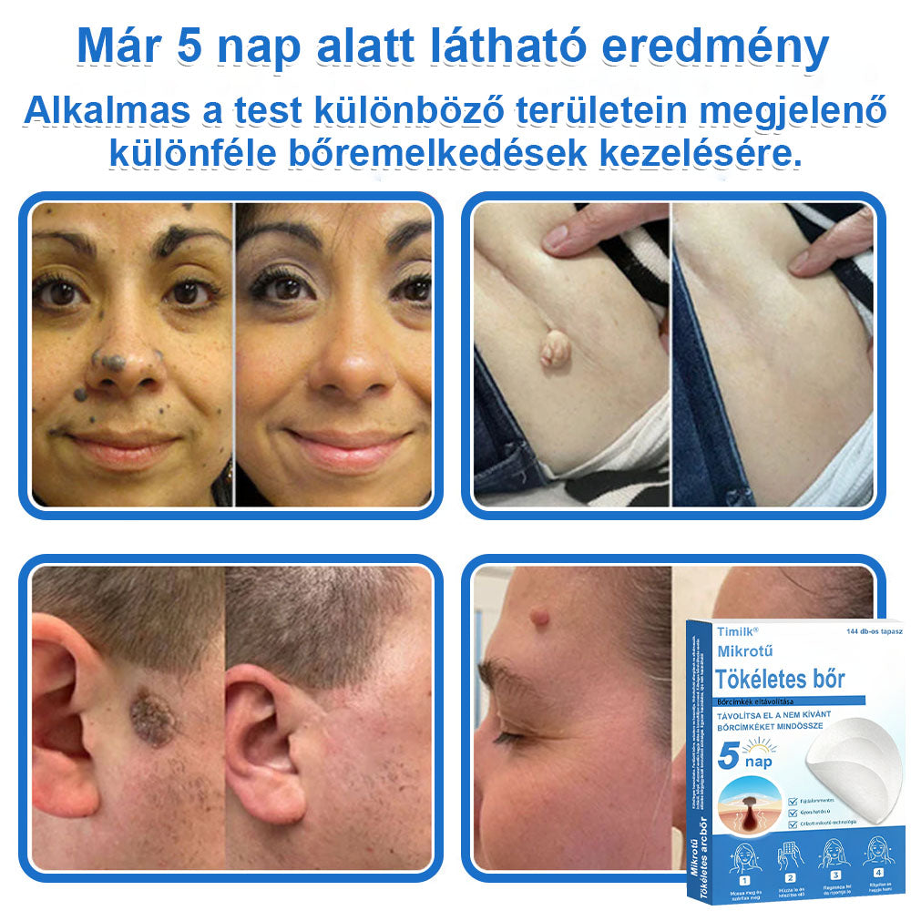 📌📌📌 Timilk® 2 az 1-ben mikrotűs és hidrokolloid tapasz | Kiemelkedő anyajegyek, pattanások, lapos szemölcsök és bőrkinövések eltávolítására | Segít javítani a ráncok, hegek és bőrhibák megjelenését | Láthatatlan pattanástapasz arcra és testre📌📌