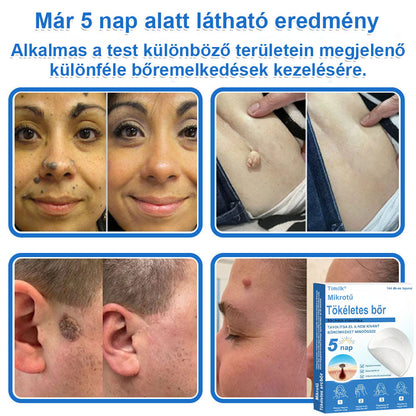 📌📌📌 Timilk® 2 az 1-ben mikrotűs és hidrokolloid tapasz | Kiemelkedő anyajegyek, pattanások, lapos szemölcsök és bőrkinövések eltávolítására | Segít javítani a ráncok, hegek és bőrhibák megjelenését | Láthatatlan pattanástapasz arcra és testre📌📌