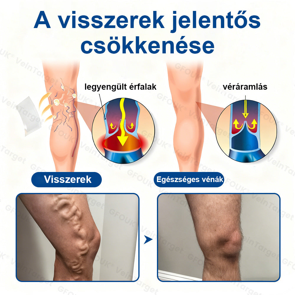 ✅Laleia® Vein Ease mikrotűs tapasz
