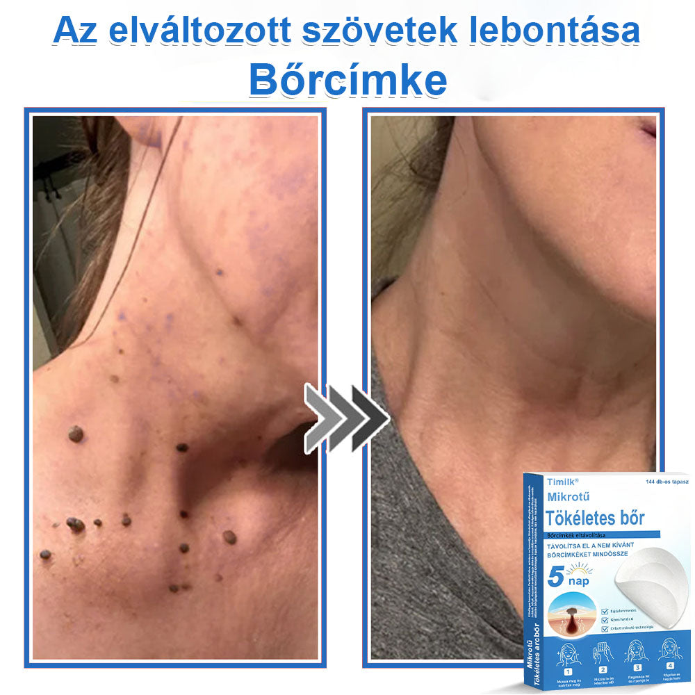 📌📌📌 Timilk® 2 az 1-ben mikrotűs és hidrokolloid tapasz | Kiemelkedő anyajegyek, pattanások, lapos szemölcsök és bőrkinövések eltávolítására | Segít javítani a ráncok, hegek és bőrhibák megjelenését | Láthatatlan pattanástapasz arcra és testre📌📌