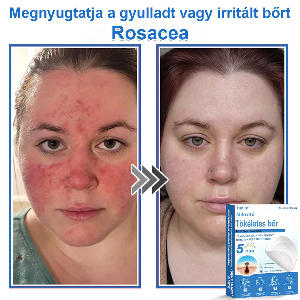 📌📌📌 Timilk® 2 az 1-ben mikrotűs és hidrokolloid tapasz | Kiemelkedő anyajegyek, pattanások, lapos szemölcsök és bőrkinövések eltávolítására | Segít javítani a ráncok, hegek és bőrhibák megjelenését | Láthatatlan pattanástapasz arcra és testre📌📌