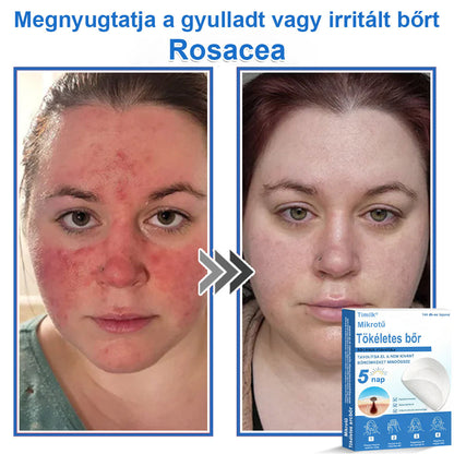 📌📌📌 Timilk® 2 az 1-ben mikrotűs és hidrokolloid tapasz | Kiemelkedő anyajegyek, pattanások, lapos szemölcsök és bőrkinövések eltávolítására | Segít javítani a ráncok, hegek és bőrhibák megjelenését | Láthatatlan pattanástapasz arcra és testre📌📌