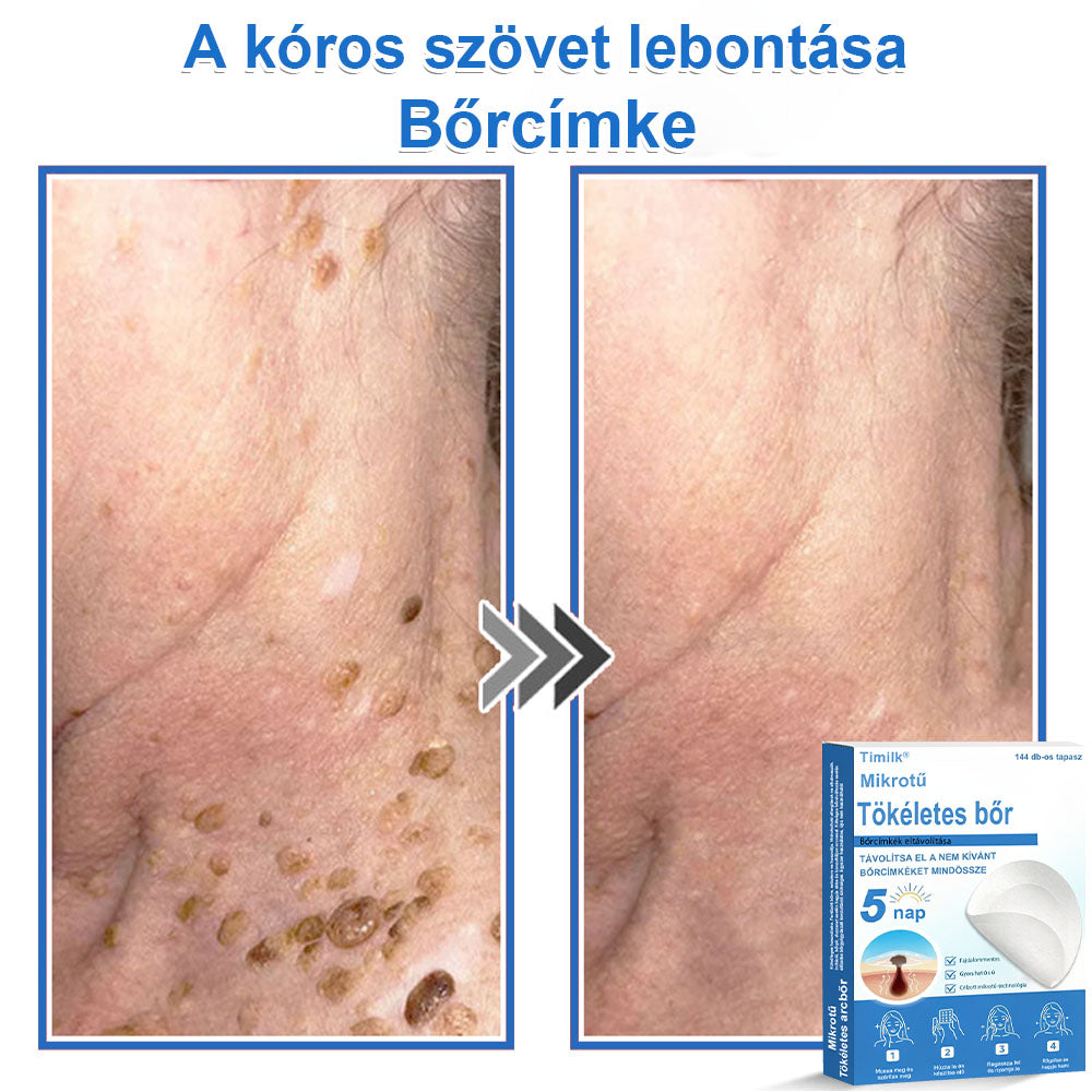 📌📌📌 Timilk® 2 az 1-ben mikrotűs és hidrokolloid tapasz | Kiemelkedő anyajegyek, pattanások, lapos szemölcsök és bőrkinövések eltávolítására | Segít javítani a ráncok, hegek és bőrhibák megjelenését | Láthatatlan pattanástapasz arcra és testre📌📌