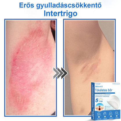 📌📌📌 Timilk® 2 az 1-ben mikrotűs és hidrokolloid tapasz | Kiemelkedő anyajegyek, pattanások, lapos szemölcsök és bőrkinövések eltávolítására | Segít javítani a ráncok, hegek és bőrhibák megjelenését | Láthatatlan pattanástapasz arcra és testre📌📌
