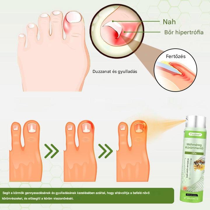 🔥A legnépszerűbb丨Korlátozott ideig 50%-os kedvezmény | Foulme® NailRescue Méhméreg Spray🐝